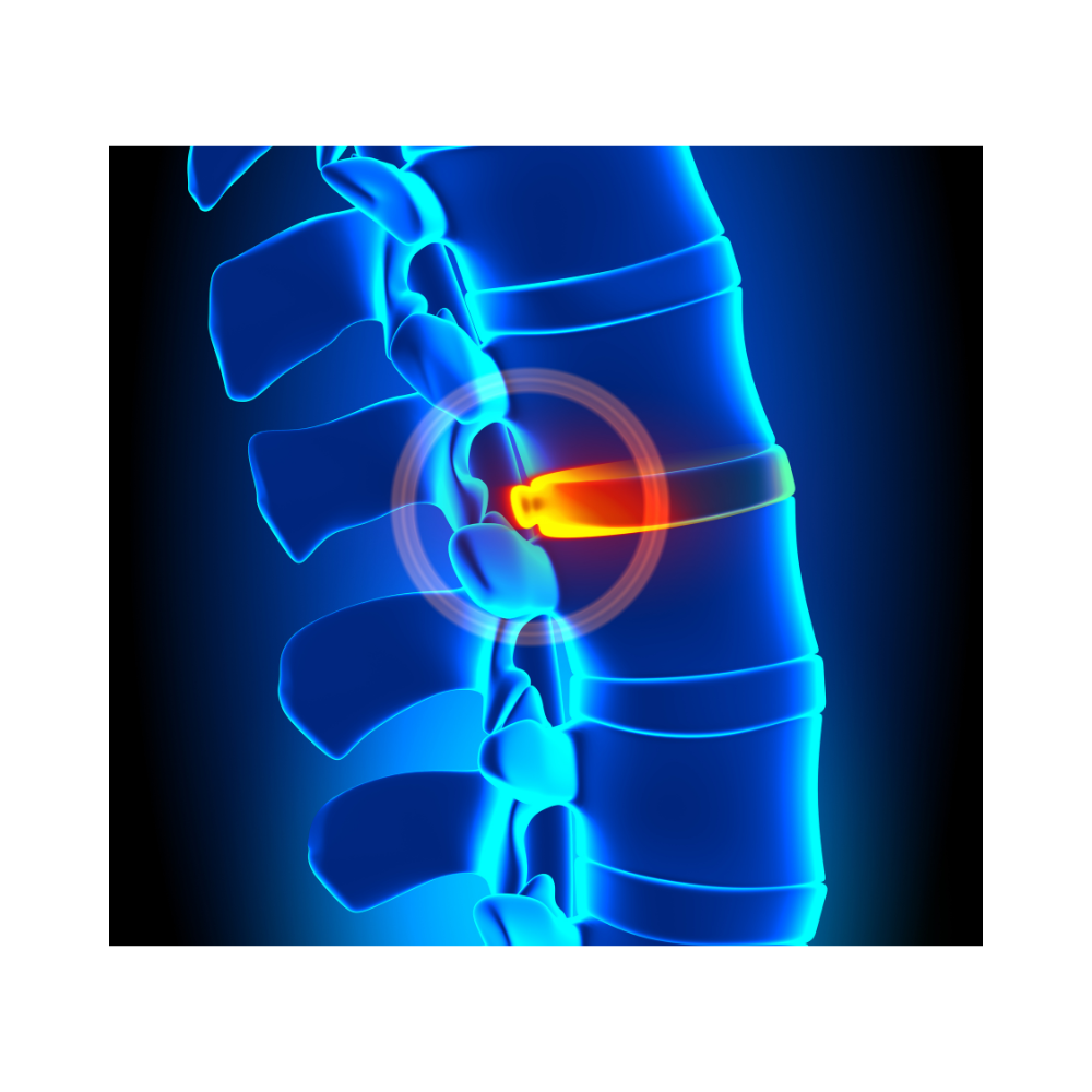 illustration of disc in the spine with a highlighted pain point.