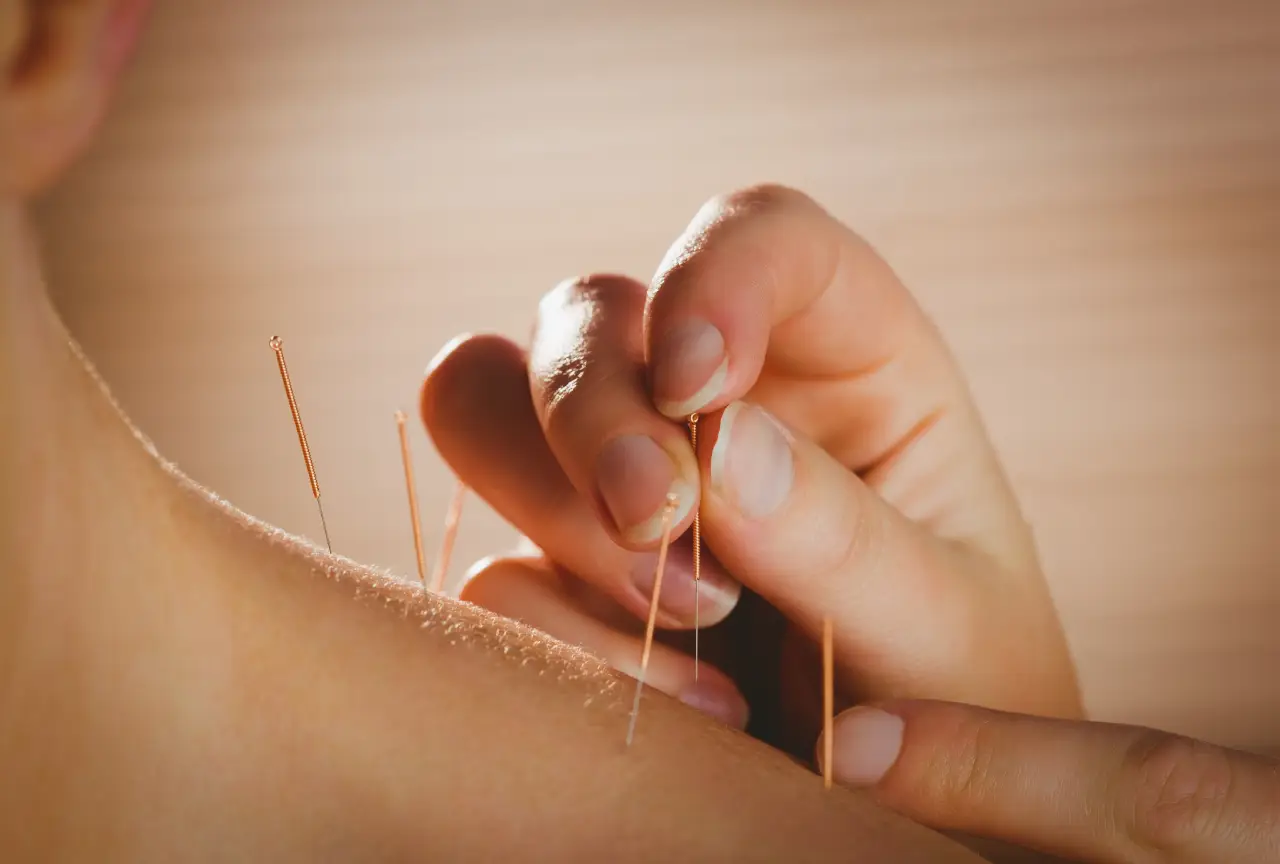 dry needling/IMS