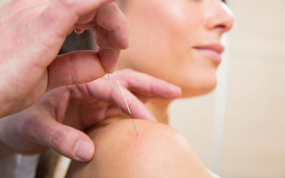 dry needling for shoulder sherwood park