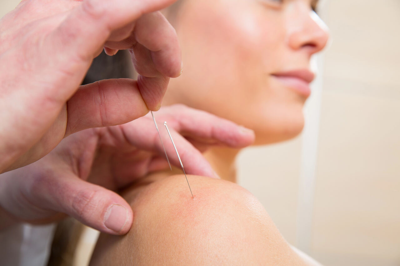 dry needling for shoulder sherwood park