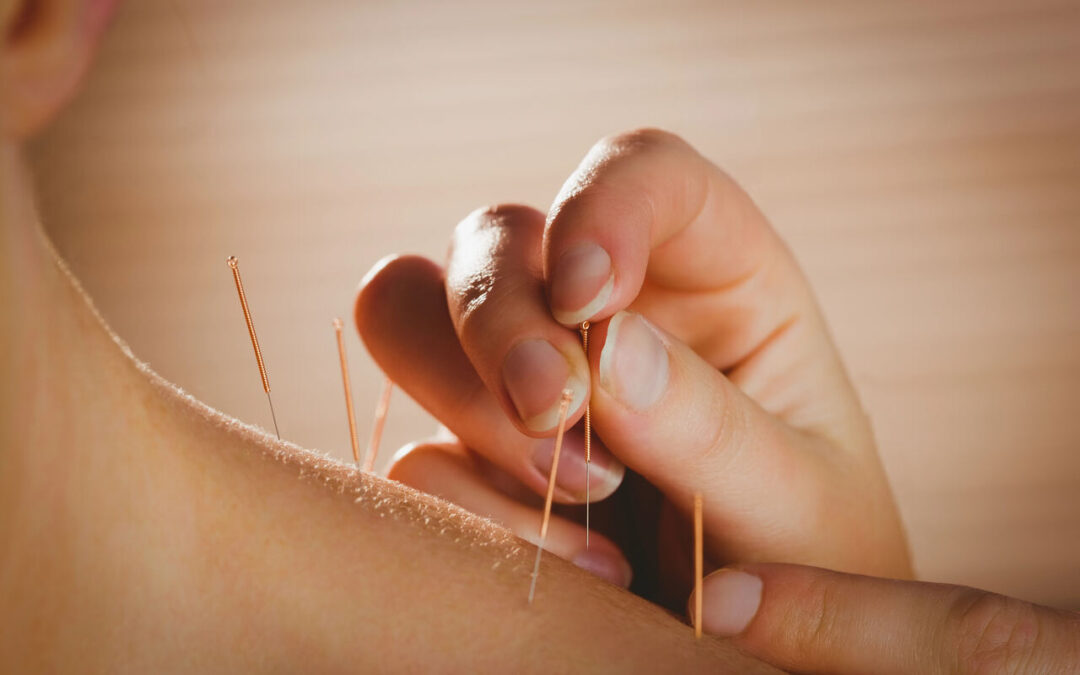 dry needling for frozen shoulder sherwood park