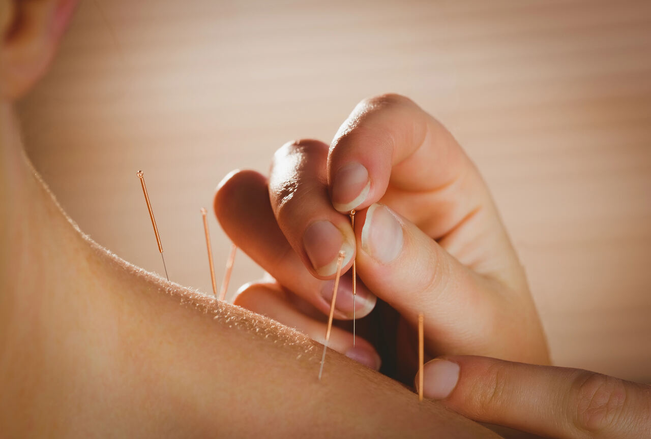 dry needling for frozen shoulder sherwood park