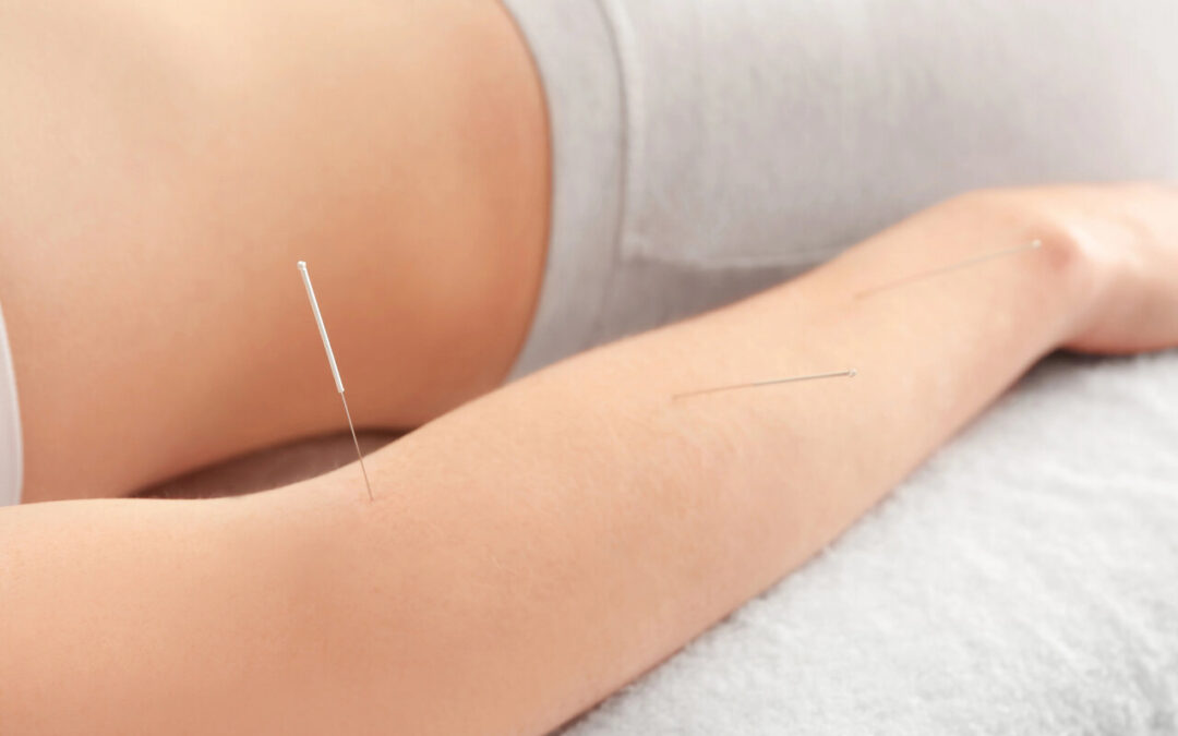 dry needling for tennis elbow sherwood park