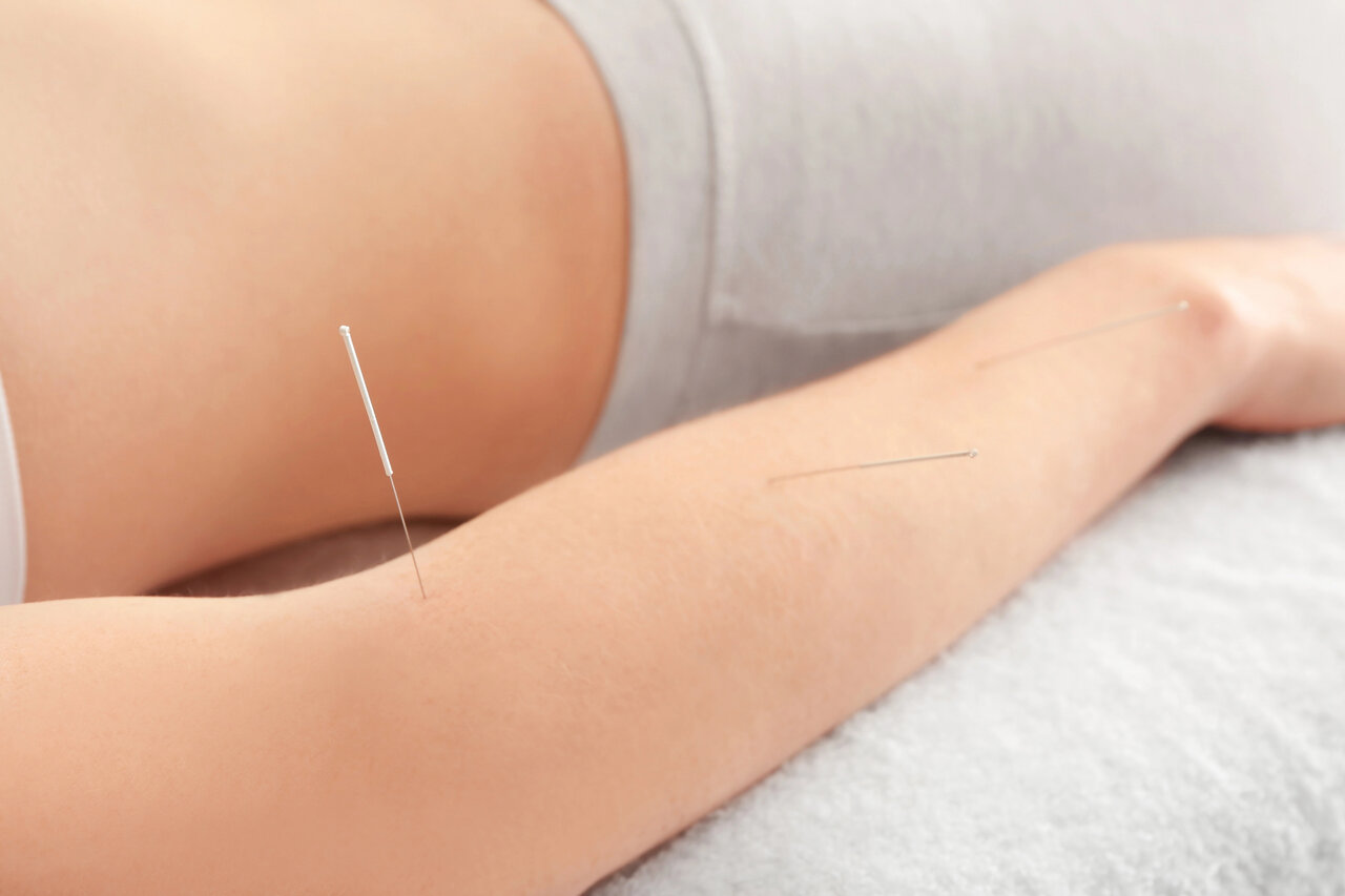 dry needling for tennis elbow sherwood park