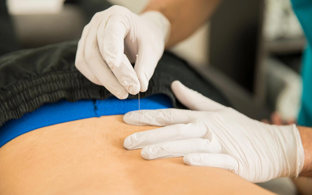 Dry Needling for Sciatica: How It Works and What to Expect