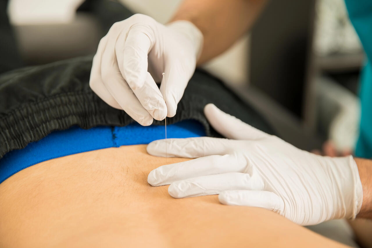 dry needling for sciatica sherwood park