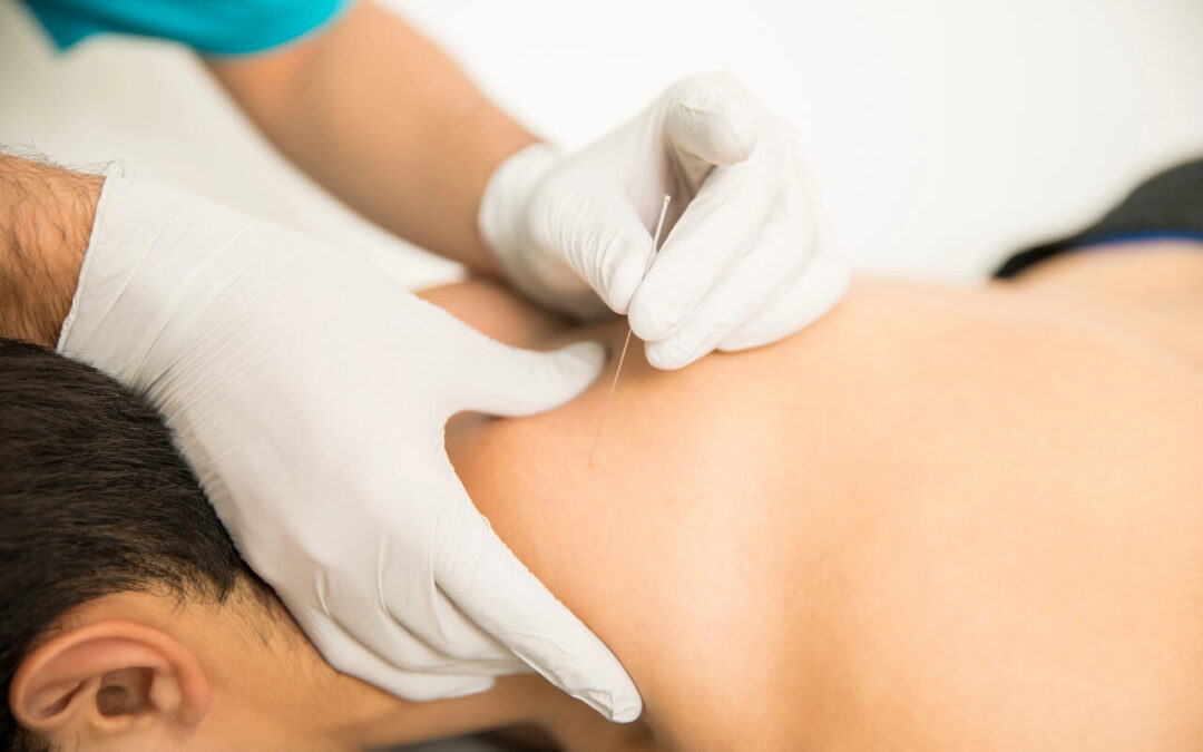 Faster Healing and Functional Rehab: Exploring the Benefits of Dry Needling
