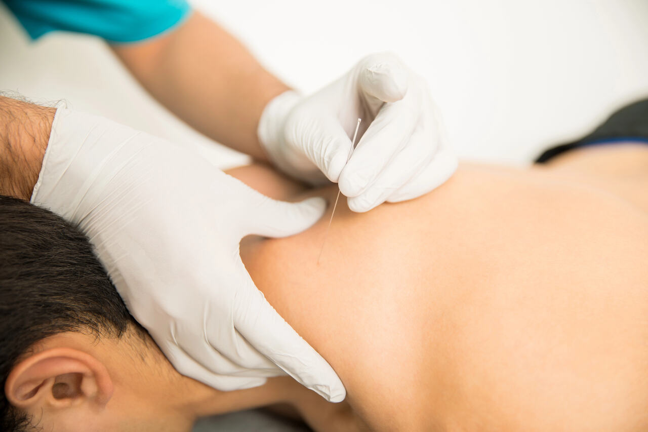 benefits of dry needling sherwood park